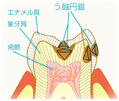 むし歯の進行を数値化〜ダイアグノデントペン〜