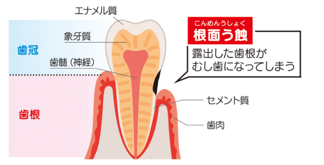 根面う蝕に気をつけましょう〜大人もフッ素でむし歯予防〜