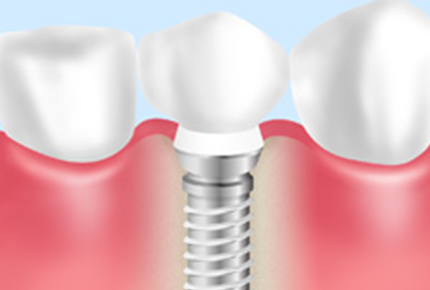 インプラント治療