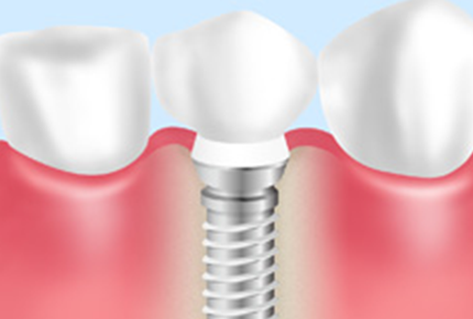 インプラント治療