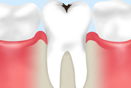 むし歯の治療と予防について