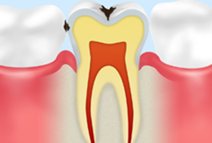 C1【エナメル質のむし歯】
