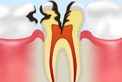 C3【神経に達した虫歯】