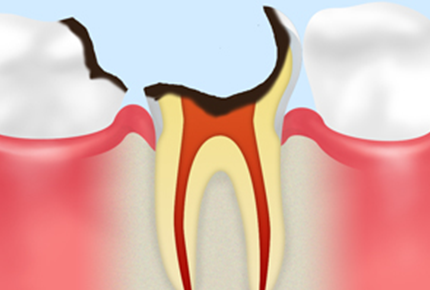 C4【歯の根に達した虫歯】