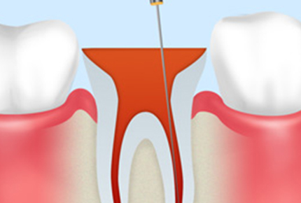 神経まで達してしまったむし歯について　～根管治療～