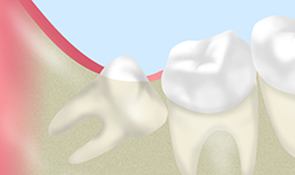 親知らずの治療もご相談ください
