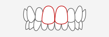 出っ歯(軽度)