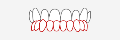受け口（下の歯が前にでている）