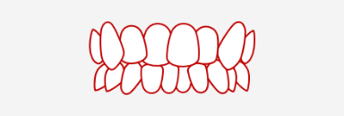 歯の重なりが激しい