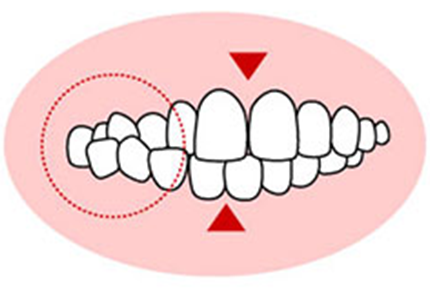 交叉咬合(こうさこうごう)